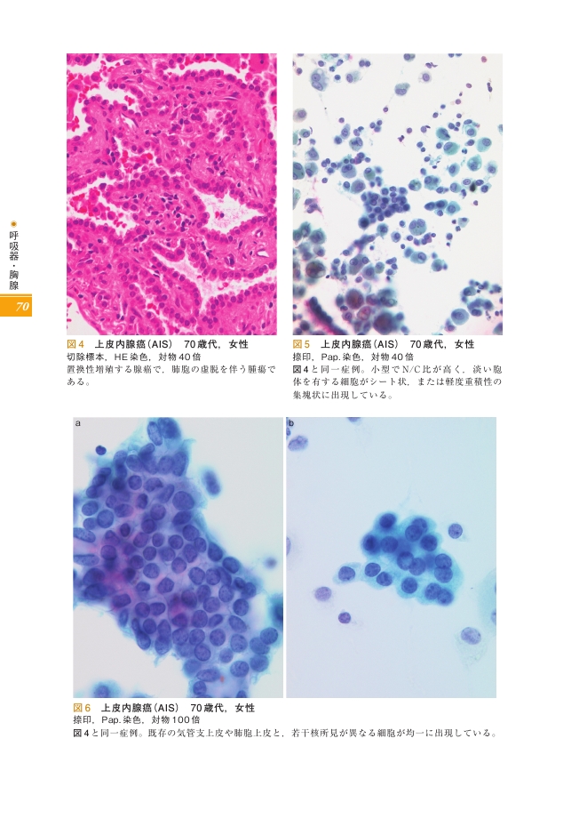 細胞診ガイドライン 4 呼吸器・胸腺・体腔液・リンパ節 2015年版