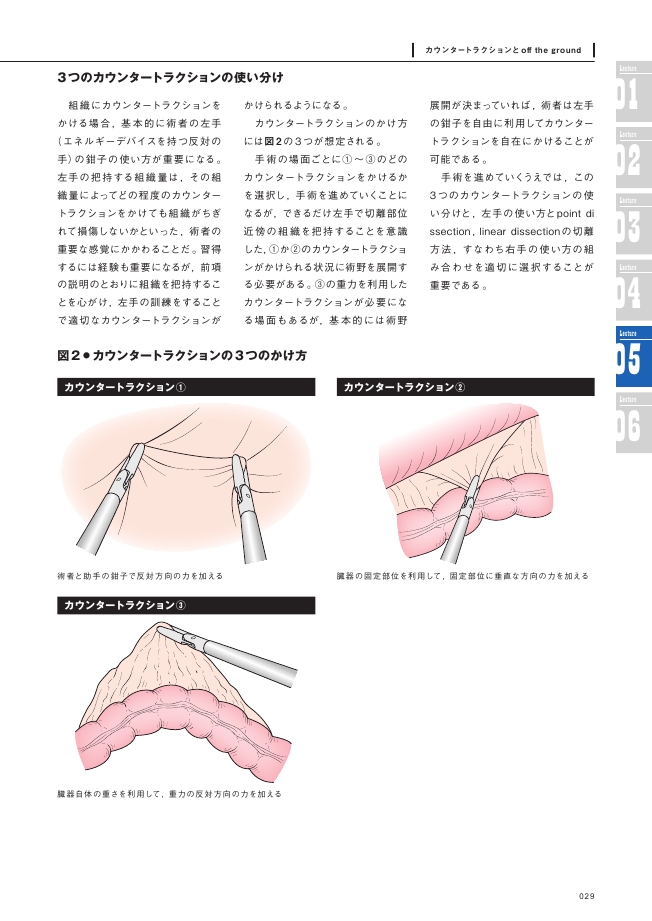 腹腔鏡下S状結腸切除術徹底レクチャー