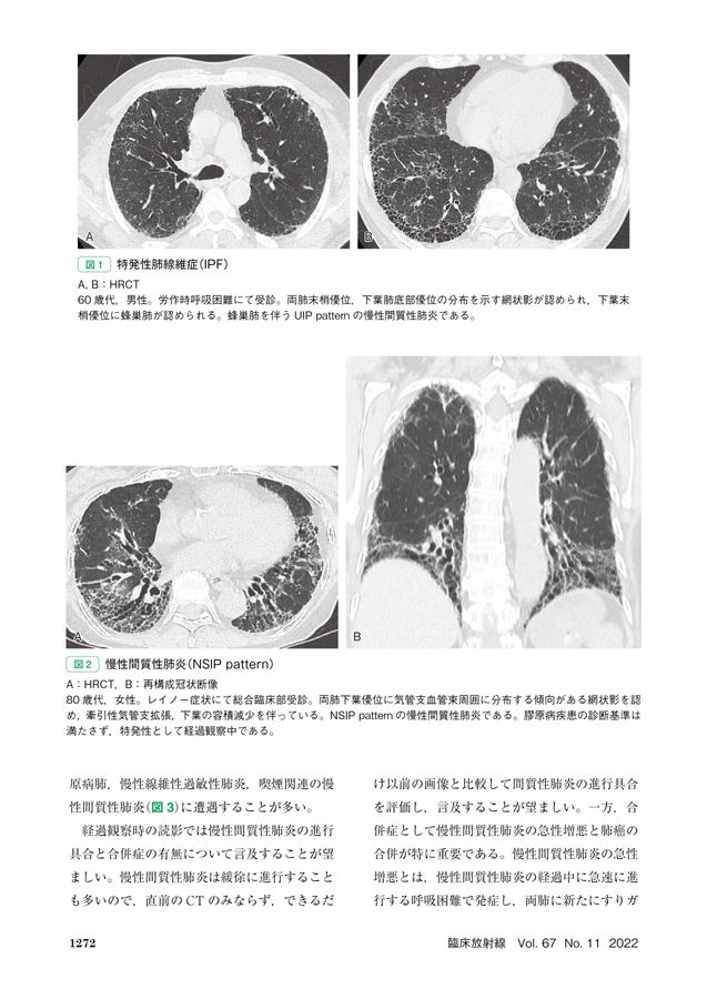 間質性肺炎の臨床　画像　診断　裁断 間質性肺炎の臨床 画像 診断 裁断 Cases of The Week (剥離性間